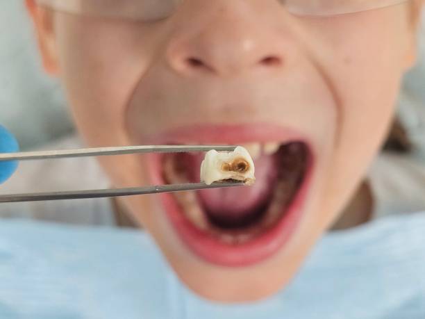 Best Emergency Tooth Extraction in South Browning, MT